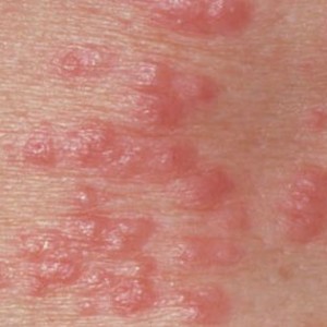 Можно ли заразиться генитальным герпесом Как передается генитальный герпес?