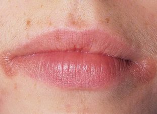 Фото: хейлит