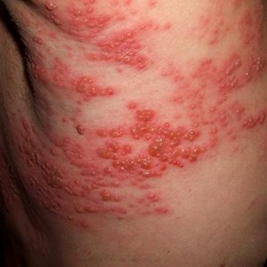 Симптомы опоясывающего герпеса Симптомы опоясывающего герпеса и способы лечения заболевания