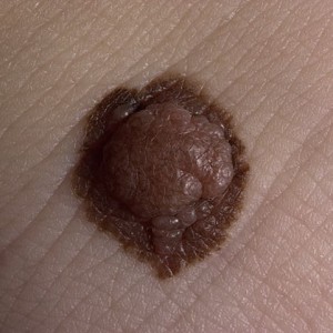 В чем опасность бородавочного невуса Бородавчатый невус: особенности, возникновение и лечение