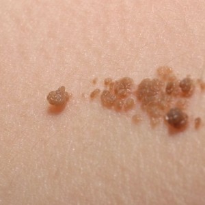 Веррукозный бородавчатый невус Бородавчатый невус: особенности, возникновение и лечение