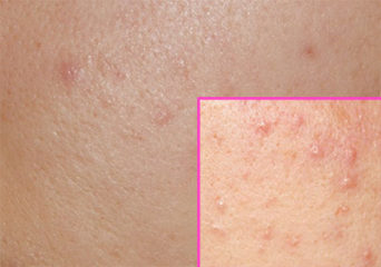 Угревая сыпь