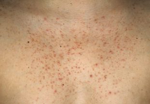 Фото: угревая сыпь при глистах