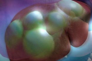 Фото: эхинококковые кисты на печени