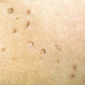 Почему появляются папилломы Отчего появляются папилломы на теле, способы их лечения