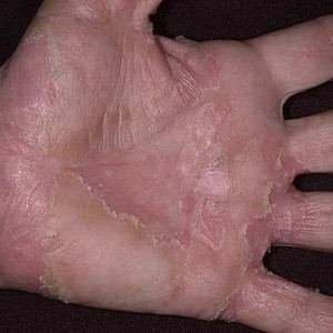 Сухая экзема Сухая экзема на руках: как вылечить?