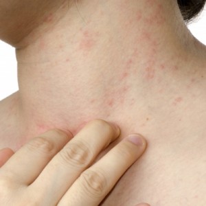 Причины красных пятен на шее Покраснение и шелушение между пальцами рук: причины