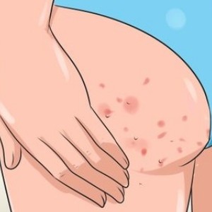 Причины герпеса Герпес на попе: особенности проявления и лечение