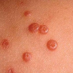 Причины возникновения папиллом Отчего появляются папилломы на теле, способы их лечения