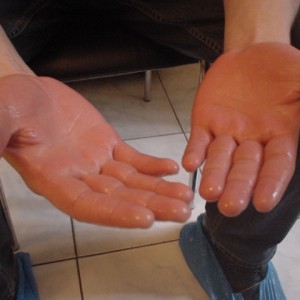 Как лечить экзему на ладонях Сложности при лечении экземы на ладонях