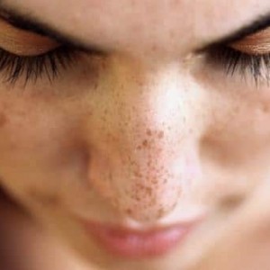Веснушки Отчего на лице появляются темные пятна