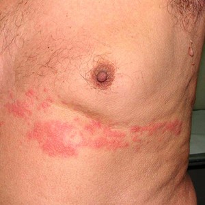 Передается ли опоясывающий лишай? Заразен ли опоясывающий лишай?