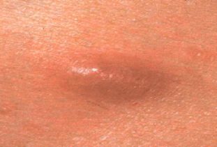 Проявление подкожной формы дирофиляриоза