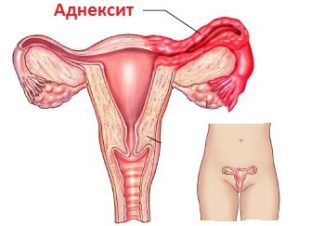 Симптомы и лечение хламидиоза во время беременности