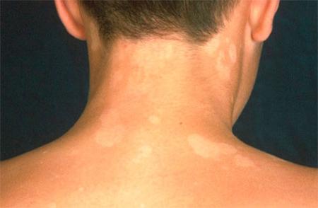 Фото белого лишая у ребенка Белый лишай клинические особенности заболевания