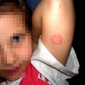 Лишай Жибера у ребенка Возникновение розового лишая у детей