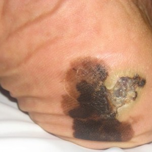 Виды меланомы Какие бывают виды меланомы и как они проявляются