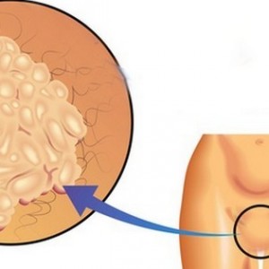 Вирус папиломмы Папилломы во влагалище: причины, симптомы, лечение