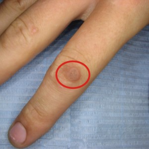 Удалить бородавку на пальце руки Возникновение бородавок на пальцах рук, лечение