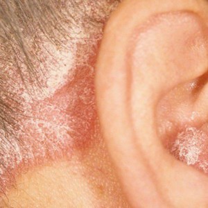 Ушной дерматит Зуд в ухе: симптоматика, причины и лечение