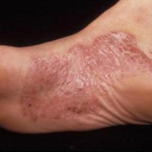 Диета при псориазе Старый недуг. Пути борьбы с псориазом