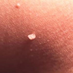 Как лечить папилломавирус у женщин Методы лечения папилломавируса у женщин