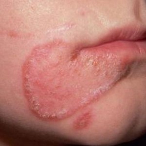 Розовый лишай на лице Розовый лишай у человека: симптомы и лечение