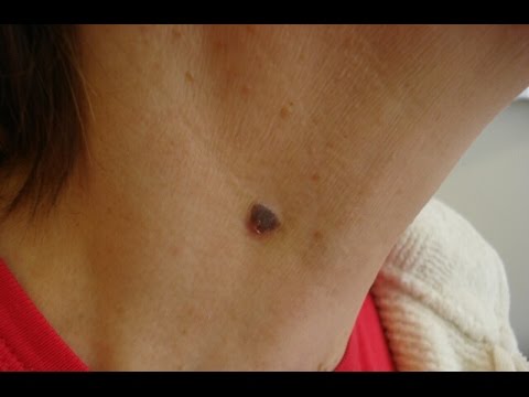 Кератопапиллома Причины появления кератопапиллом: методы лечения, фото