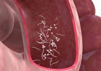 Глисты у человека