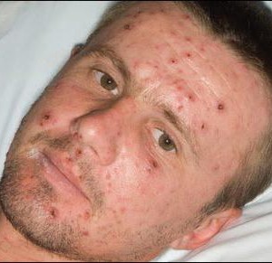 Признаки ветрянки у взрослых симптомы Насколько опасна ветрянка у взрослых?