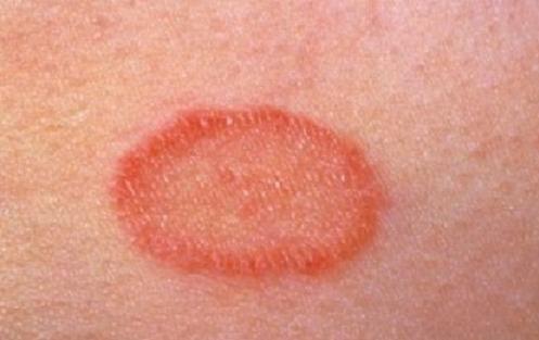 Розовый лишай Возникновение розового лишая у детей