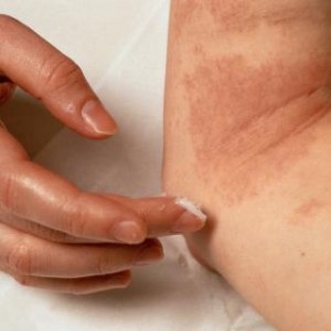 Лечение нейродермита Нейродермит: лечим домашними способами