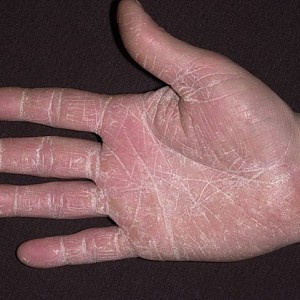 Грибковое поражение кожи рук Покраснение и шелушение между пальцами рук: причины