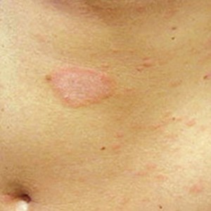 Розовый лишай на теле Розовый лишай у человека: симптомы и лечение