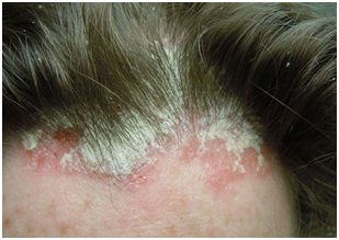 Стригущий лишай у человека Стригущий лишай у человека: симптомы и способы лечения