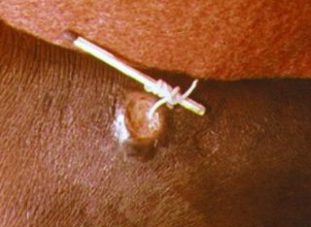 Извлечение червя ришты