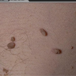 Лечение папилломавируса у женщин Методы лечения папилломавируса у женщин