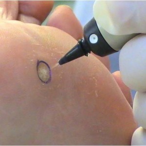 Лечение подошвенной бородавки Способы лечения бородавки на стопе ребёнка