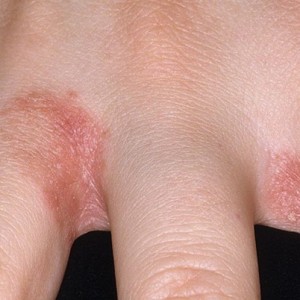 Причины покраснения и шелушения кожи Покраснение и шелушение между пальцами рук: причины