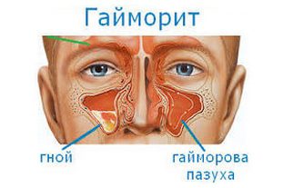 Как проявляется хламидиоз у детей и как его лечить?