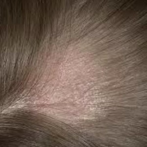 Лечение стригущего лишая у человека Начальная стадия лишая у человека