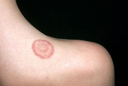 Материнская бляшка лишая Жибера Розовый лишай у человека: симптомы и лечение