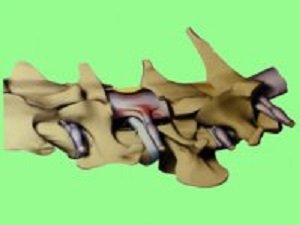 грыжа межпозвоночного диска у собаки