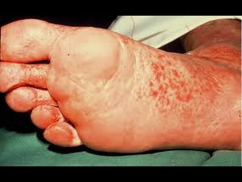 Грибок стопы крайней формы Грибок стопы: симптомы заболевания и лечение народными средствами