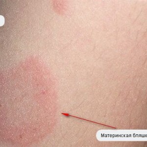 Причины розового лишая Возникновение розового лишая у детей