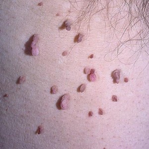 Причины появления папиллом Папилломы человека: причины возникновения и лечение вируса