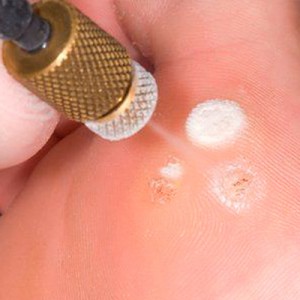 Удаление бородавки азотом Способы лечения бородавки на стопе ребёнка