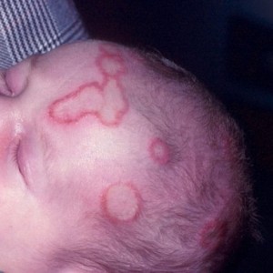 Розовый лишай у грудничка Возникновение розового лишая у детей