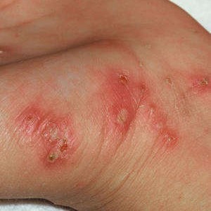 Симптомы чесотки у человека Симптомы и первые признаки чесотки (фото)