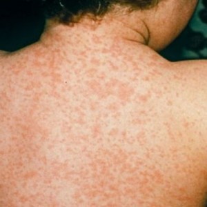 Симптомы дерматоза Дерматозы: что это такое и как нужно лечиться